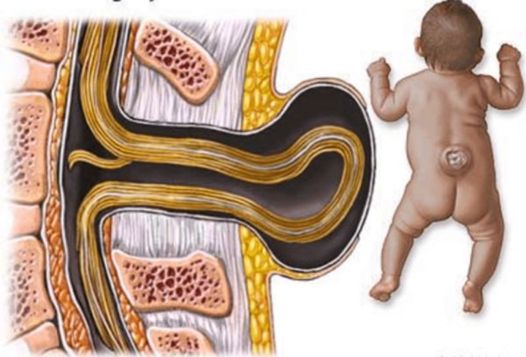 Gai đôi cột sống có nang hình thành do bẩm sinh ngay từ khi còn trong bụng mẹ