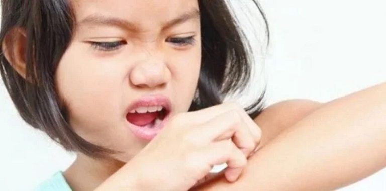Lác đồng tiền ở trẻ em khiến trẻ ngứa ngáy khó chịu
