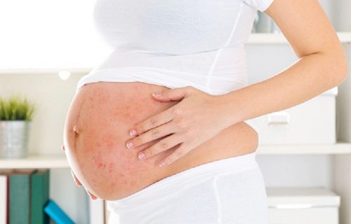 Mẹ bầu bị dị ứng thời tiết chữa thế nào