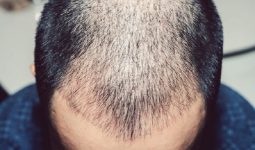 Tóc rụng nhiều ở nam do DHT gây ra