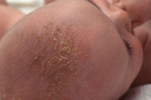 Viêm da tiết bã da đầu hay còn gọi là “cứt trâu” là bệnh thường gặp ở trẻ sơ sinh
