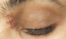 Zona thần kinh ở mắt thường xuất hiện tại mí mắt, hốc mắt,v.v..