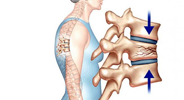 Cấu tạo xương bị rạn nứt là một nguyên nhân gây ra tình trạng đứng thẳng bị đau lưng