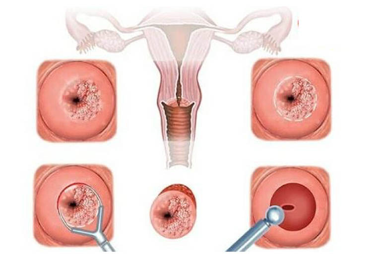 viêm cổ tử cung là bệnh phụ khoa thường gặp sau sinh