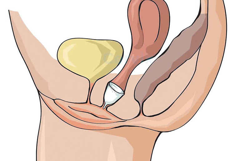 Đẩy cốc nguyệt san vào cửa âm đạo ở góc 45 độ hướng về phía xương mu