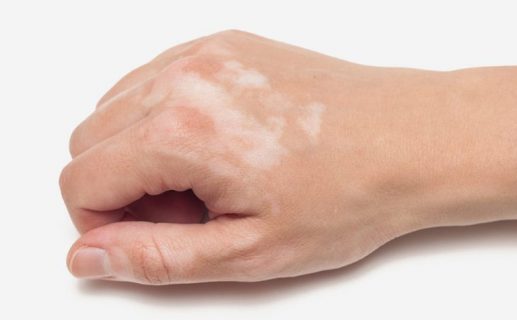cách trị lang ben tại nhà