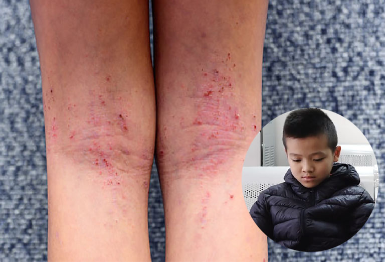 Hình ảnh những tổn thương ngoài da do viêm da cơ địa ở bé Trần Đức Trung