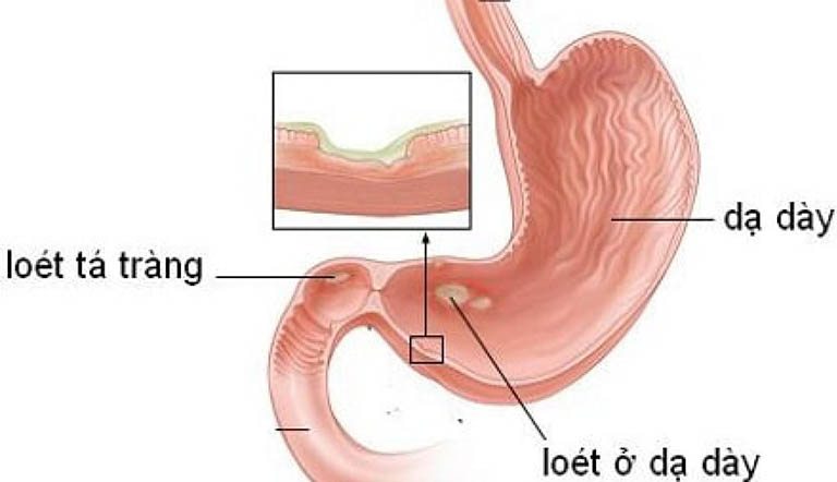 Đau bụng ở rốn có thể là triệu chứng cảnh báo của những bệnh lý về dạ dày - tá tràng