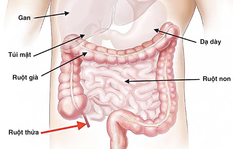 Đau bụng quanh rốn là một trong những biểu hiện sớm của bệnh viêm ruột thừa