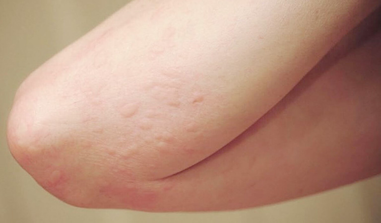 Nổi mẩn trên da là dấu hiệu thường gặp