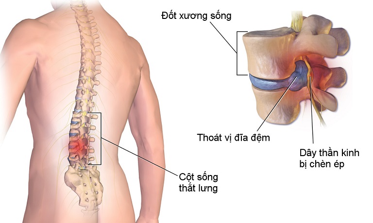 Thoát vị đĩa đệm là nguyên nhân dẫn tới tình trạng đau lưng