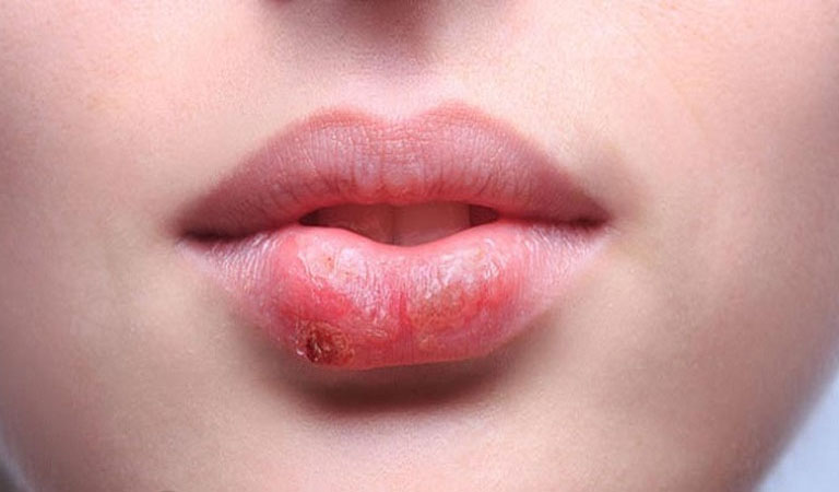 Chàm môi luôn khiến người bệnh cảm thấy khó chịu