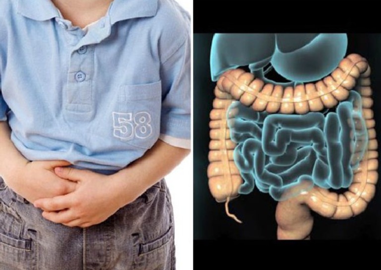 Đau bụng quanh rốn là triệu chứng thường xảy ra ở những trẻ mắc hội chứng ruột kích thích