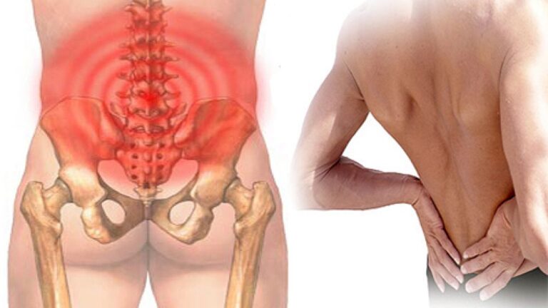Hội chứng thắt lưng hông hình thành do nhiều yếu tố