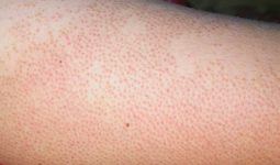 Viêm lỗ chân lông ở tay là hiện tượng da bị viêm nhiễm, bít tắc