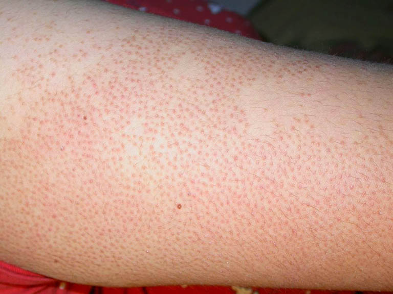 Viêm lỗ chân lông ở tay là hiện tượng da bị viêm nhiễm, bít tắc