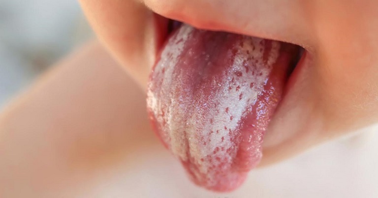 Nhiễm nấm candida miệng họng là tình trạng nhiễm nấm men phổ biến