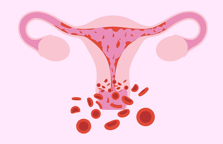 Rối loạn kinh nguyệt do viêm niêm mạc tử cung, viêm nhiễm đường sinh dục