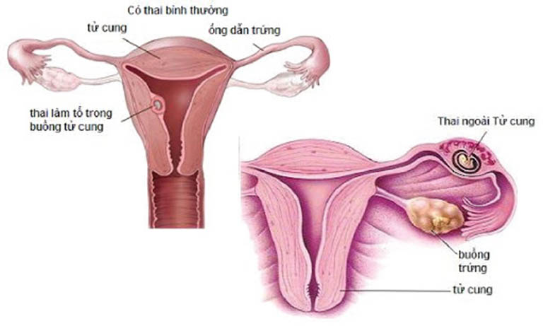Rối loạn kinh nguyệt là triệu chứng cảnh báo ung thư niêm mạc tử cung, chửa ngoài tử cung