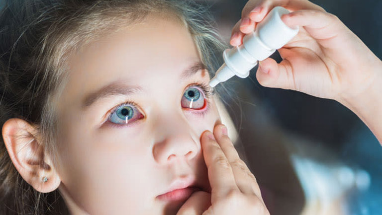 Thuốc nhỏ mắt có thể giảm nhanh các triệu chứng dị ứng ở mắt