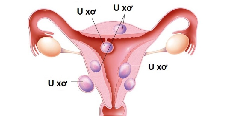 Hình ảnh về bệnh u xơ tử cung ở nữ giới