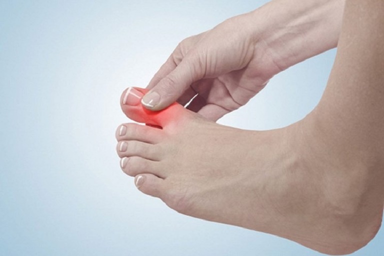 Khớp ngón chân bị viêm có thể gây ra hiện tượng đau đầu ngón chân
