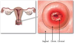 Viêm lộ tuyến cổ tử cung là gì? Dấu hiệu, điều trị