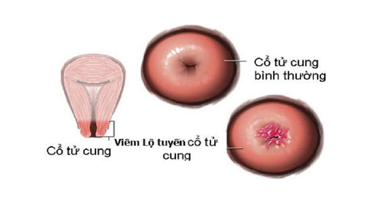 Viêm lộ tuyến cổ tử cung có ảnh hưởng đến thai nhi không là thắc mắc của nhiều chị em hiện nay