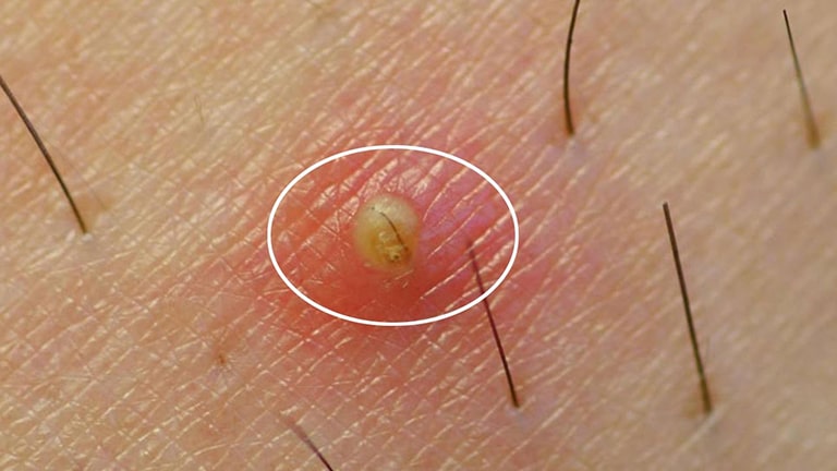 Giai đoạn tạo mủ tại lỗ chân lông gây đau đớn cho người bệnh