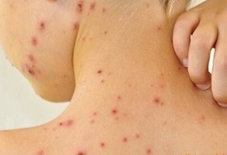 Bệnh ghẻ ruồi gây ra các tổn thương trên da với kích thước nhỏ trông giống như con ruồi