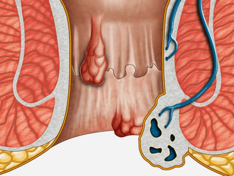 La chair saillante dans l'anus après une hémorroïdectomie peut être un symptôme d'hémorroïdes récurrentes