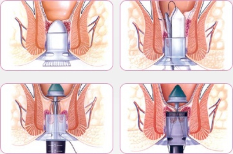 Couper la chair saillante au niveau de l'anus par la méthode mini-invasive HCPT