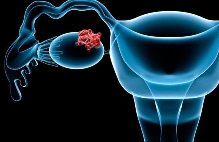 Lạc nội mạc tử cung gia tăng nguy cơ ung thư buồng trứng
