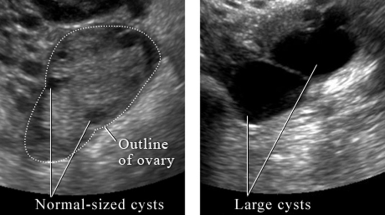 Hình bên trái cho thấy các nang nhỏ kích thước bình thường, hình 2 cho thấy các nang lớn ảnh hưởng tới buồng trứng và có thể gây đau