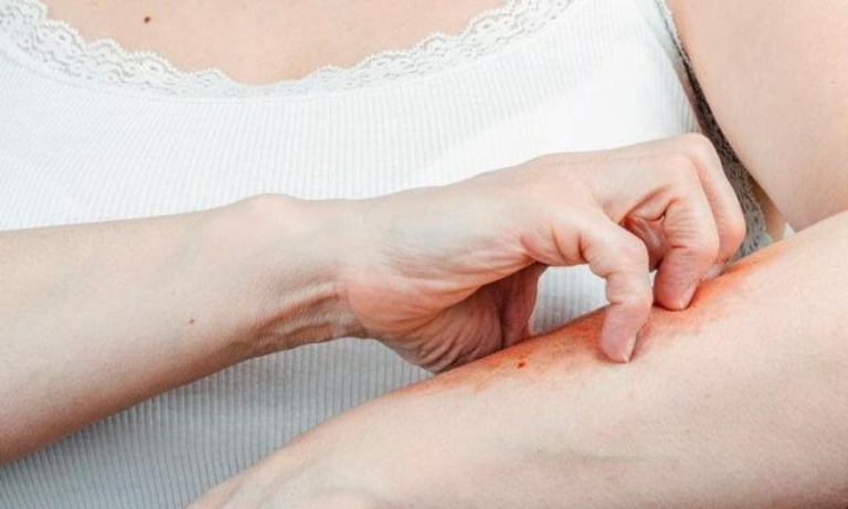 Thói quen để móng tay dài và cào gãi lên da là yếu tố làm gia tăng nguy cơ mắc bệnh
