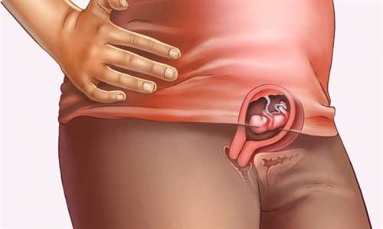 Sự phát triển của thai nhi bên trong tử cung gây áp lực lên các tĩnh mạch là nguyên nhân gây ra bệnh trĩ ở bà bầu