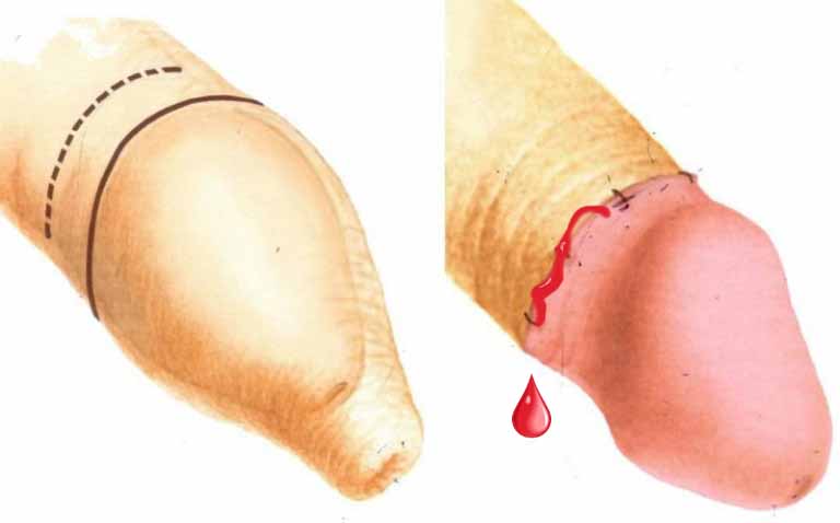 Vết cắt bao quy đầu có thể bị chảy máu nếu bệnh nhân vận động quá mạnh