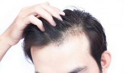 Rụng tóc androgen là gì? Cách nhận biết và điều trị