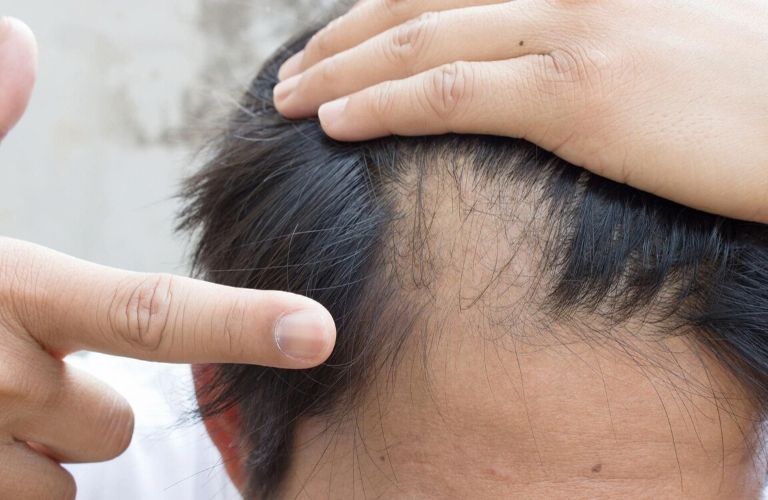 Có rất nhiều nguyên nhân khiến tóc rụng từng mảng