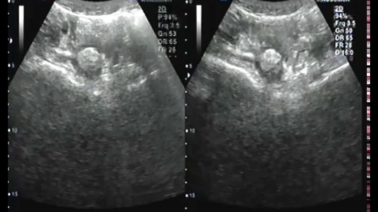 Hình ảnh siêu âm u nang buồng trứng