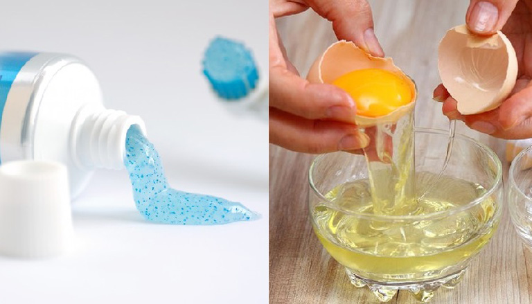 Trứng gà kết hợp kem đánh răng có khả năng điều trị nám