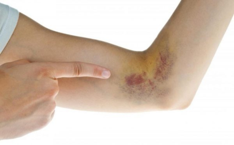Xuất hiện các vết bầm bất thường dưới da là triệu chứng phổ biến của rối loạn đông máu