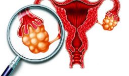 Phân biệt u nang buồng trứng cơ năng và thực thể
