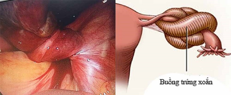 Xoắn u nang là biến chứng thường thấy nhất của u nang buồng trứng
