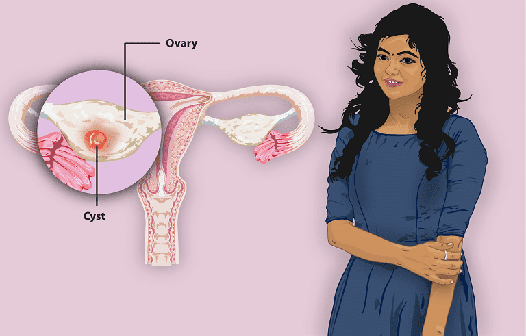 U nang buồng trứng là căn bệnh nguy hiểm, cần được điều trị kịp thời
