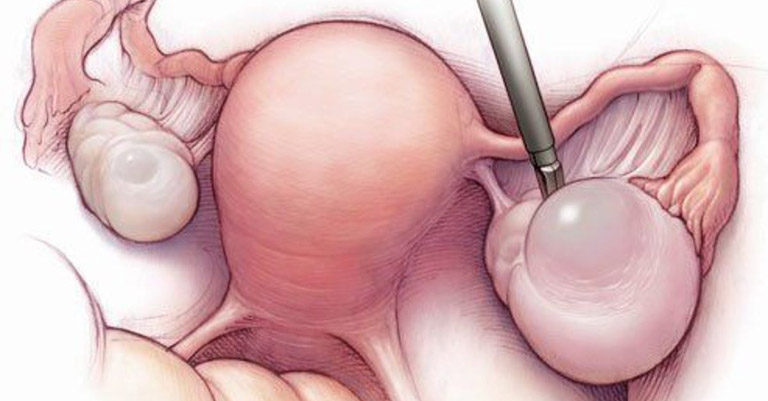 Bên cạnh nang cơ năng buồng trứng và nang hoàng thể, u nang nước cũng là dạng u nang buồng trứng phổ biến