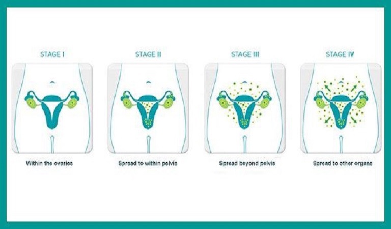 Các giai đoạn phát triển của ung thư buồng trứng