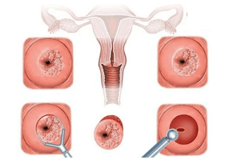 Nguyên nhân gây viêm cổ tử cung khi mang thai ở nữ giới