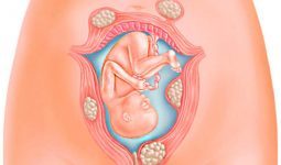 Mẹ bị viêm cổ tử cung gấy ảnh hưởng đến thai nhi