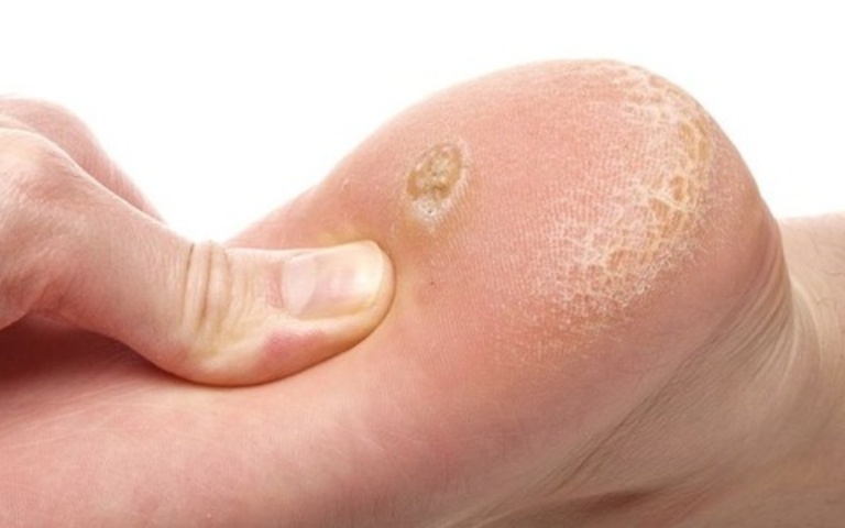 Kết hợp vôi và xà phòng diệt khuẩn sẽ có tác dụng làm rụng các nốt mụn cóc trên da